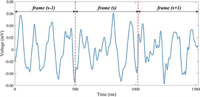 Noninvasive Assessment of Atrial Fibrillation Complexity in Relation to Ablation Characteristics and Outcome